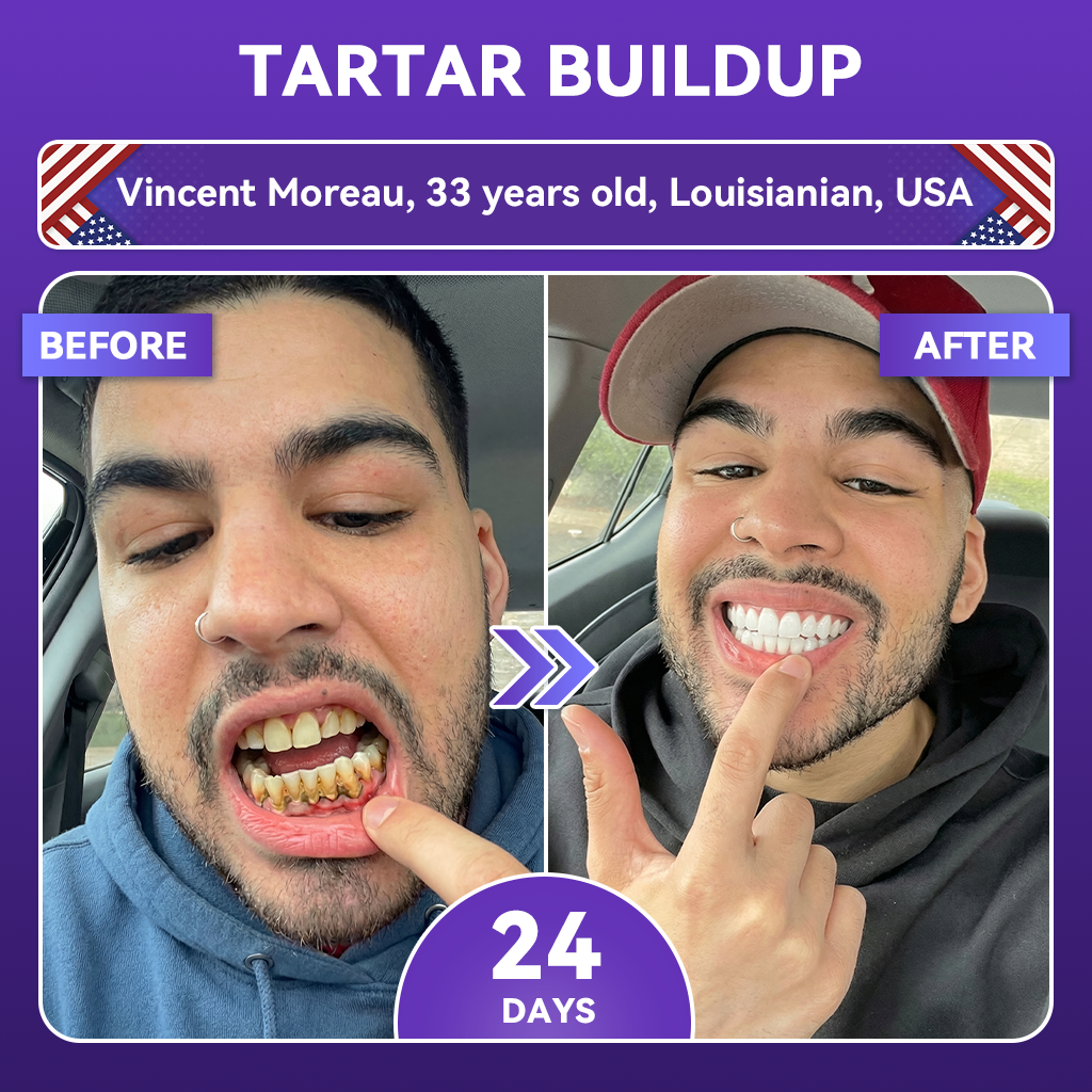 𝗚𝗹𝗶𝗺𝗺𝐞𝐫𝐥𝐲®🧮🚀10-𝒊𝒏-1 𝑨𝒅𝒗𝒂𝒏𝒄𝒆𝒅 𝑷𝒖𝒓𝒑𝒍𝒆 𝑾𝒉𝒊𝒕𝒆𝒏𝒊𝒏𝒈 𝑺𝒕𝒓𝒊𝒑𝒔 | 𝑽34 𝑶𝒑𝒕𝒊𝒄𝒂𝒍 𝑪𝒐𝒍𝒐𝒓-𝑪𝒐𝒓𝒓𝒆𝒄𝒕𝒊𝒐𝒏 & 𝒏-𝑯𝑨𝒑 𝑩𝒊𝒐-𝑹𝒆𝒑𝒂𝒊𝒓 (🛡️𝑹𝒆𝒃𝒖𝒊𝒍𝒅 𝑬𝒏𝒂𝒎𝒆𝒍 • 𝒁𝒆𝒓𝒐-𝑺𝒆𝒏𝒔𝒊𝒕𝒊𝒗𝒊𝒕𝒚 𝑷𝑨𝑷+ • 𝑰𝒏𝒔𝒕𝒂𝒏𝒕 𝒀𝒆𝒍𝒍𝒐𝒘 𝑪𝒂𝒏𝒄𝒆𝒍𝒍𝒂𝒕𝒊𝒐𝒏 • 𝑺𝒕𝒓𝒆𝒏𝒈𝒕𝒉𝒆𝒏 𝑮𝒖𝒎𝒔 • 𝑬𝒓𝒂𝒅𝒊𝒄𝒂𝒕𝒆 𝑺𝒕𝒂𝒊𝒏𝒔 & 𝑶𝒅𝒐𝒓)