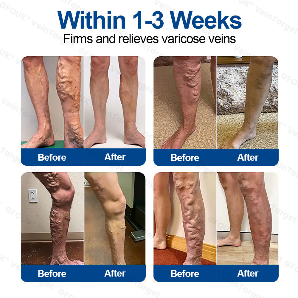 ✅𝐅𝐥𝐨𝐫𝐢𝐬𝐦𝐚® 🩸🩸𝐕𝐞𝐢𝐧𝐓𝐚𝐫𝐠𝐞𝐭 𝐌𝐢𝐜𝐫𝐨𝐧𝐞𝐞𝐝𝐥𝐞 𝐏𝐚𝐭𝐜𝐡⚡Instant Relief, Long-Term Results