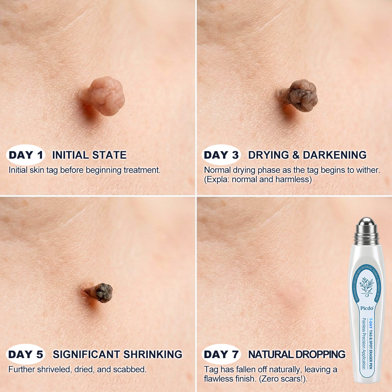 🌿🌿𝐏i𝐜𝐝o® 7-𝐷𝑎𝑦 𝗧𝐚𝐠 & 𝗦𝗽𝐨𝐭 𝐄𝐫𝒂𝒔𝒆𝒓(Zero Pain, Zero 𝐒𝐜𝐚𝒓𝒔 Rollerball)💪